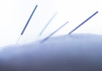 Dry-needling 3