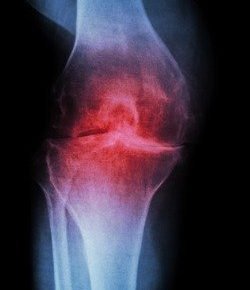 osteoarthritis-knee-picture-id484346504 Fysiotherapie bij artrose 3