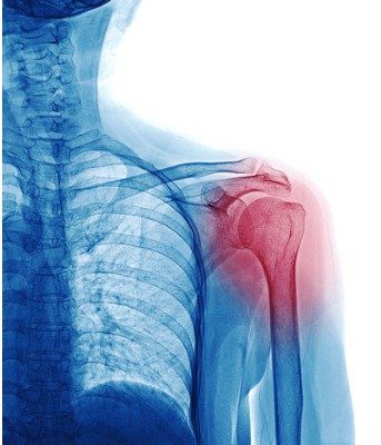 Fysiotherapie bij frozen shoulder 3