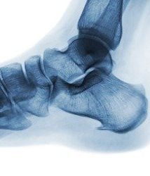 xray-normal-human-foot-lateral-view-invert-color-style-picture-id813840014 Fysiotherapie bij hielspoor 3
